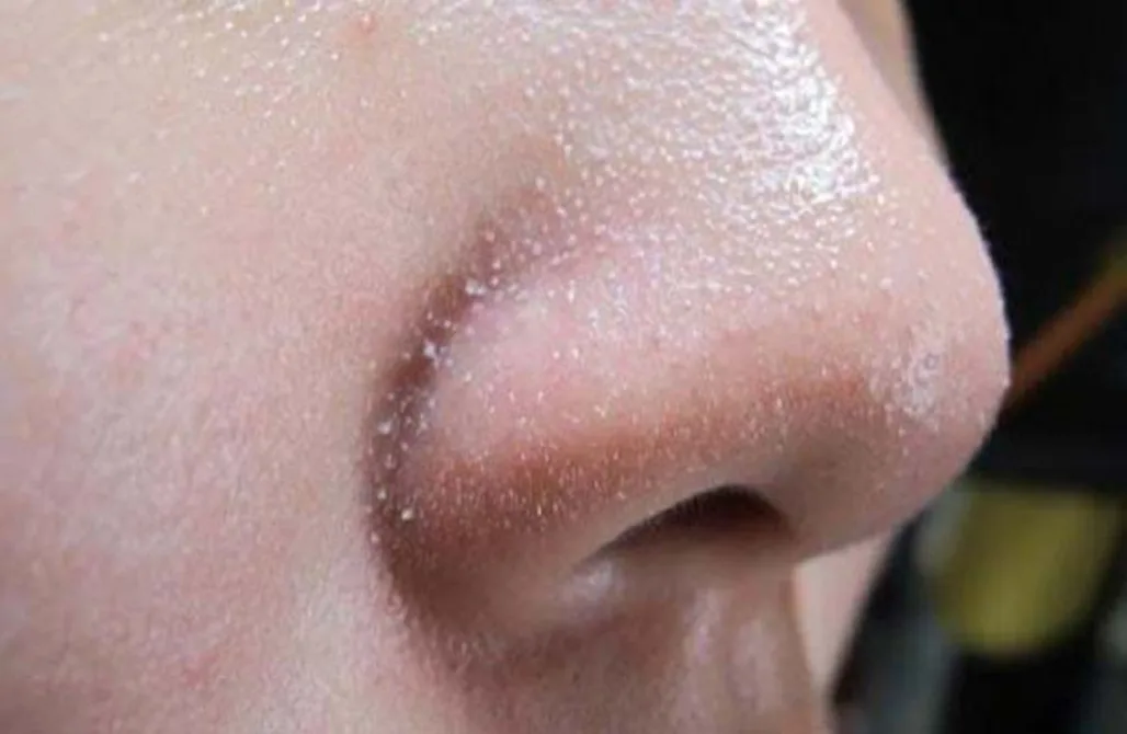 Phân biệt các loại mụn, nguyên nhân hình thành